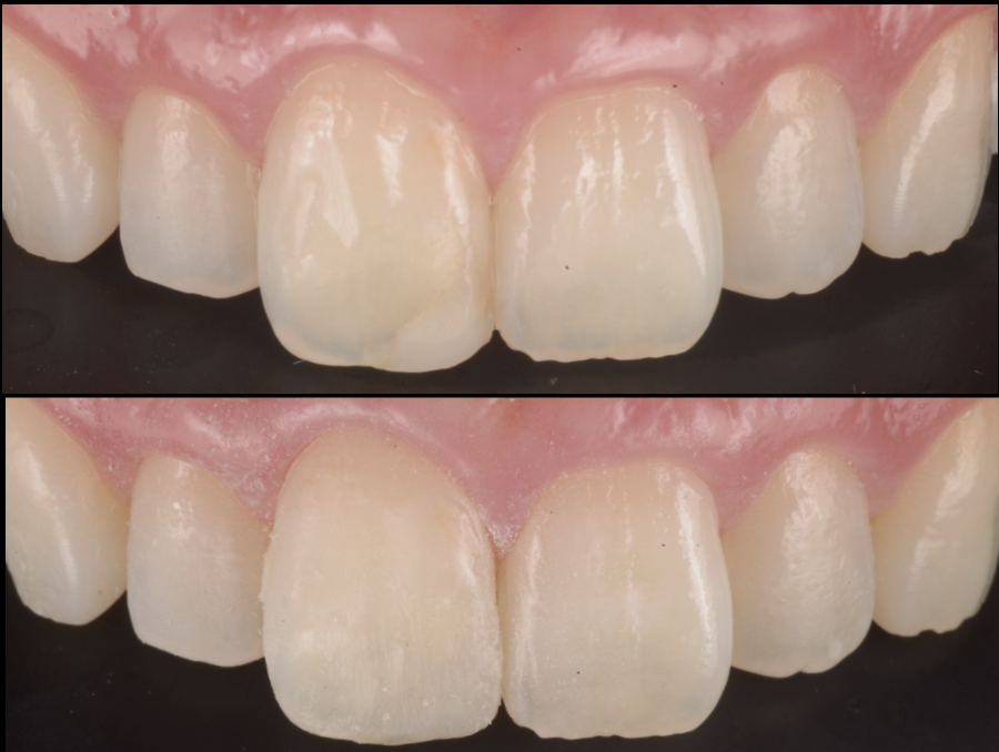 前歯の詰め物が気になる