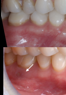 他院でセラミックを入れたが痛みが強く、膿が出ている