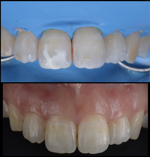 歯の白濁が気になる