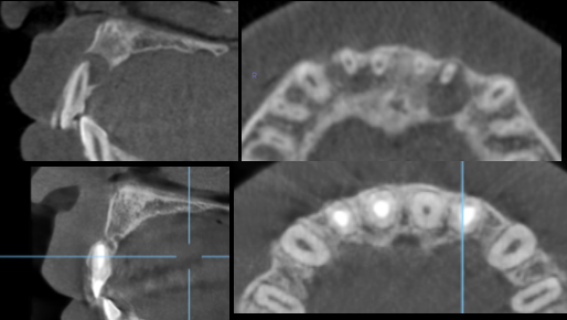 多発性歯根嚢胞を精密根管治療、歯根端切除術を行なった症例