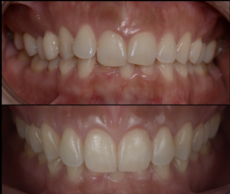 笑うと歯茎が出てしまう