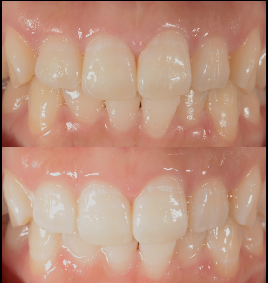 歯を白くしたい