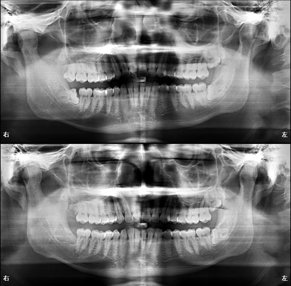 親知らずを抜きたい