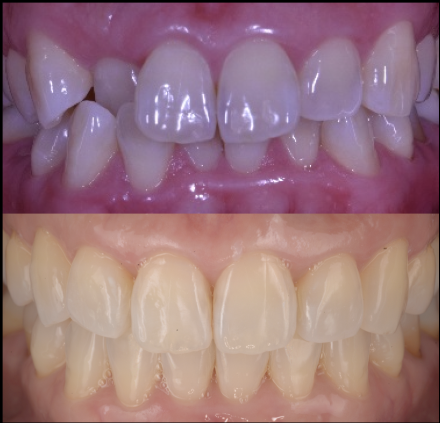 前歯が中に入っている