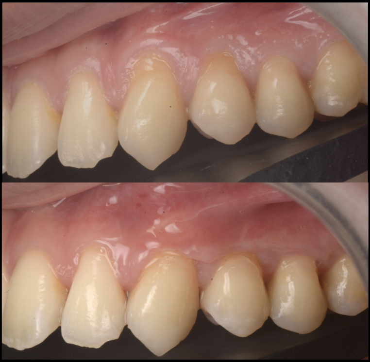 歯茎の下りが気になる