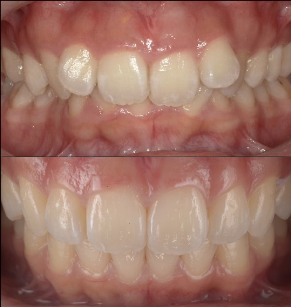歯並びを治したい
