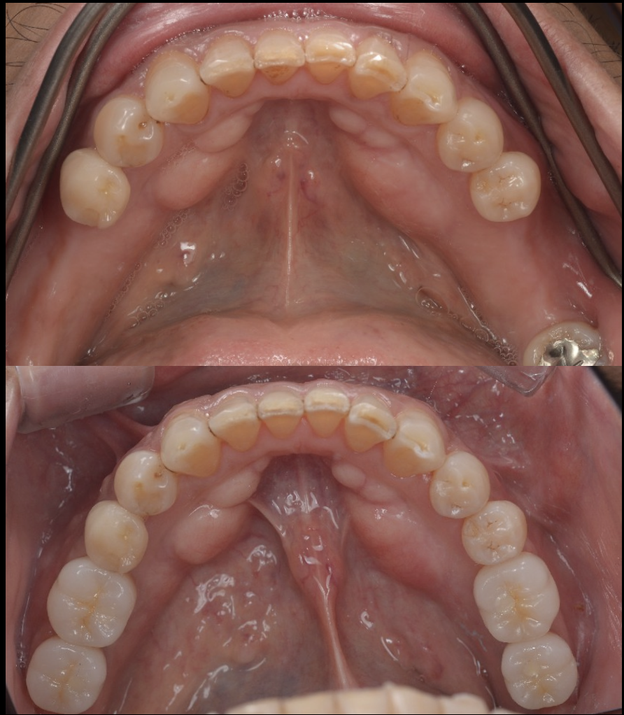 インプラントと再生療法にて両側臼歯部の咬合支持を回復させた症例