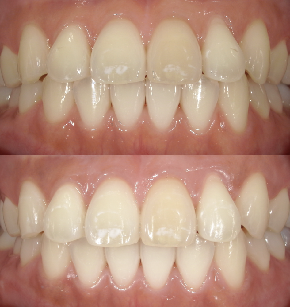 歯の黄ばみを取りたい