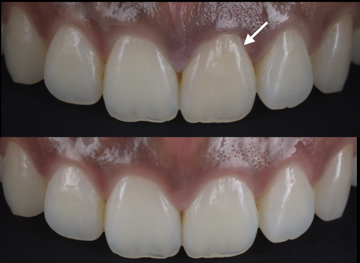 左上の前歯が暗くなって気になる