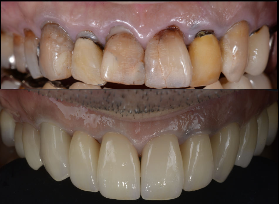 池袋で全顎的な審美・咬合再建治療｜精密根管治療・歯周再生療法・セラミックによる包括治療