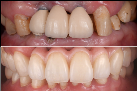 すでに入っているインプラントと追加埋入および補綴治療で審美的機能的に回復させた症例