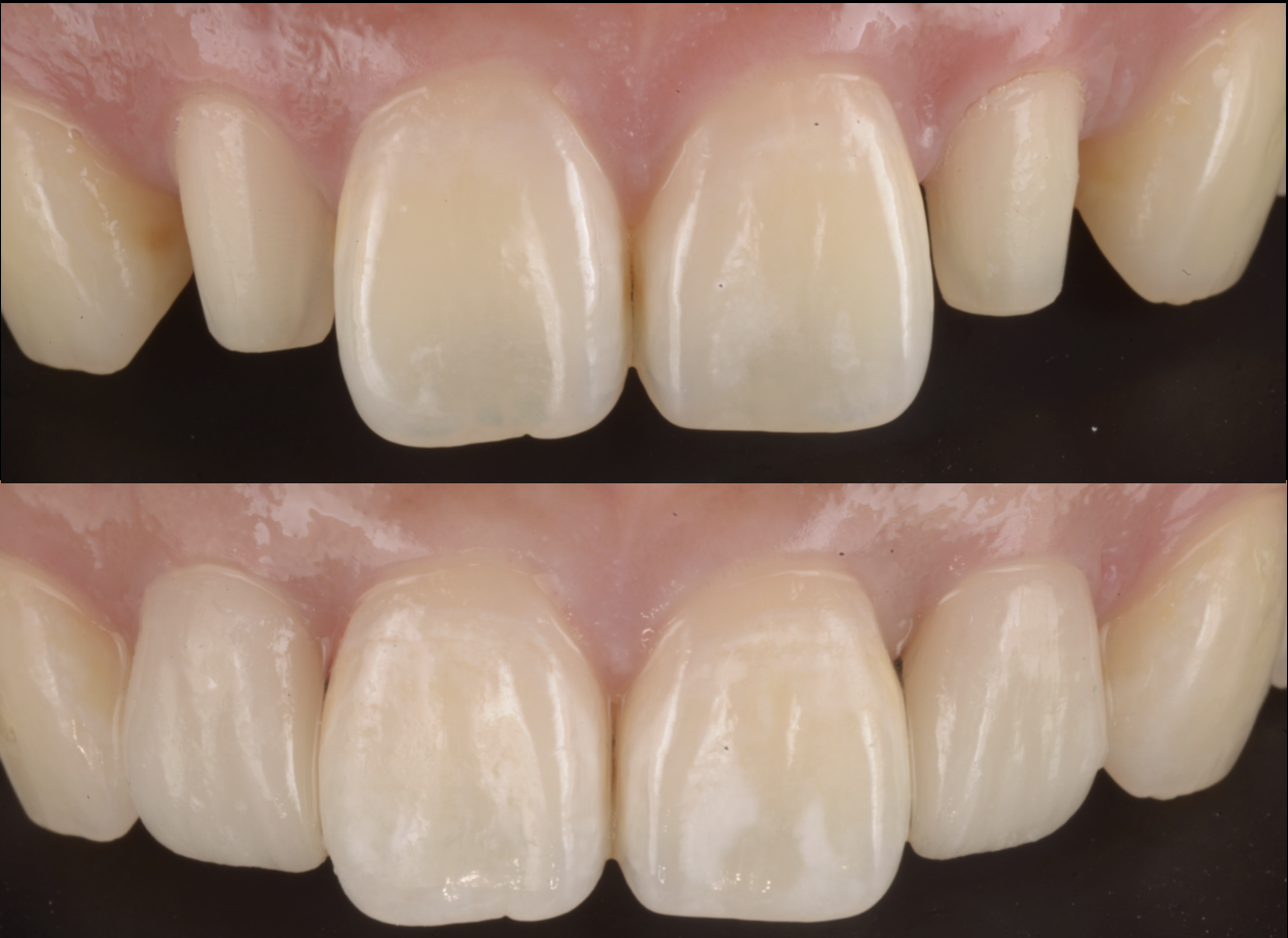 歯の隙間と前歯を引っ込めたい