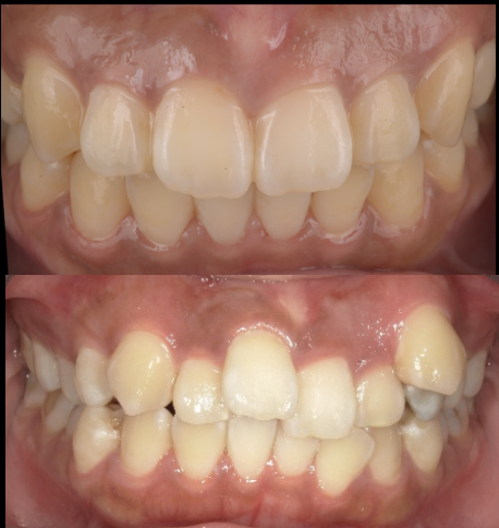 歯並びを何とかしたい