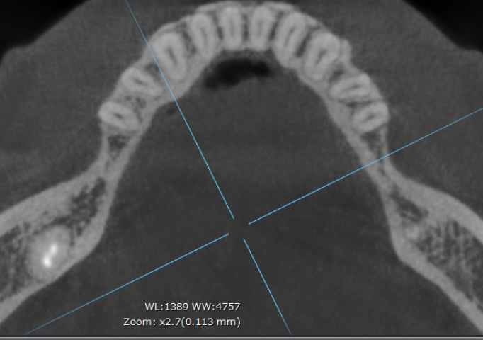 CTアキシャル像で確認するインプラント周囲の骨量（骨のバリアを意識した設計例）①