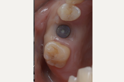 口腔内写真で確認するインプラント周囲の歯肉ボリューム（歯肉バリア：目安4mm）