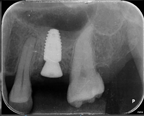 デンタルX線で確認するインプラント周囲骨（骨に覆われた状態のイメージ）