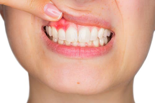 歯ぐきから膿が出る・できものができる