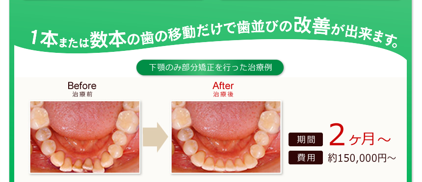 前歯のデコボコ 歯の隙間 気になるところだけ部分矯正 プチ矯正 東京 池袋 グランドメゾンデンタルクリニック