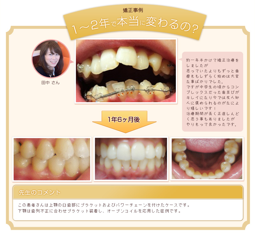 前歯のデコボコ 歯の隙間 気になるところだけ部分矯正 プチ矯正 東京 池袋 グランドメゾンデンタルクリニック
