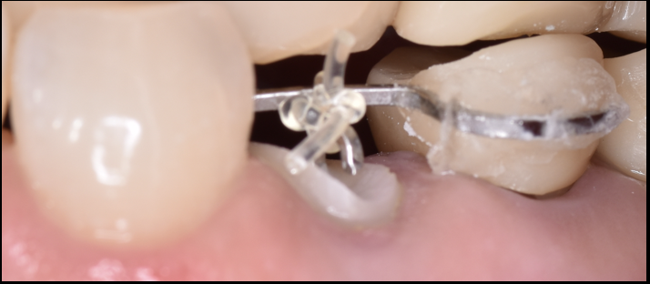 折れた歯を残す「エクストルージョン」という選択肢｜池袋の歯科からご提案