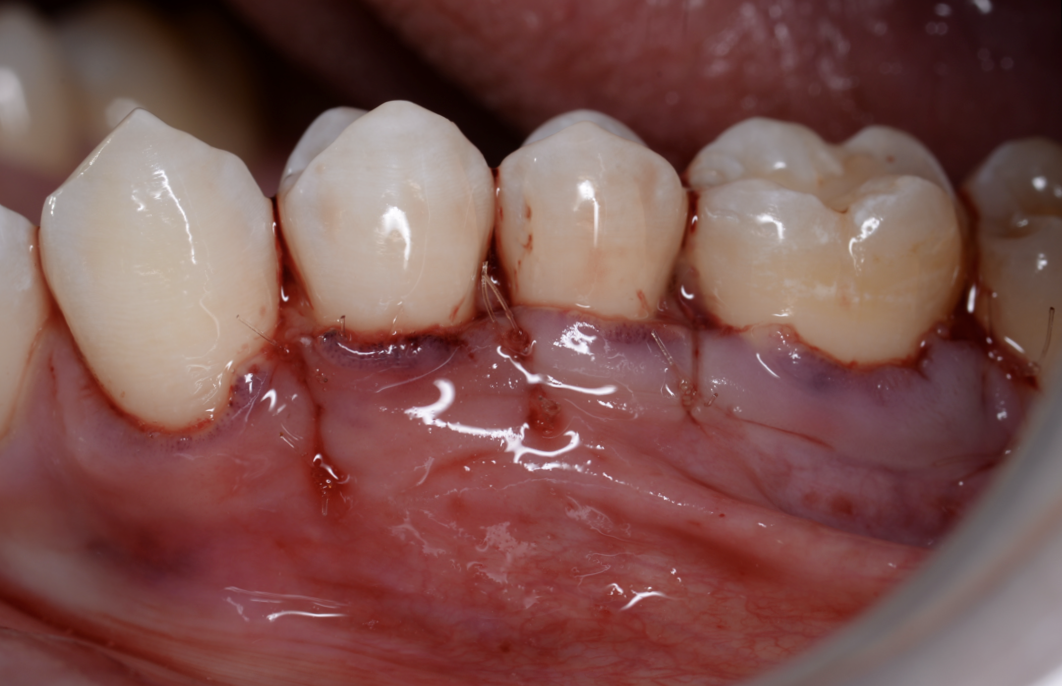 【池袋｜歯肉退縮の治療】結合組織移植術によるルートカバレッジで健康的で美しい歯ぐき