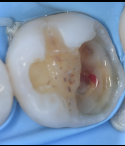 【池袋｜歯髄温存療法（VPT）】神経を残す最先端の虫歯治療｜グランドメゾンデンタルクリニック