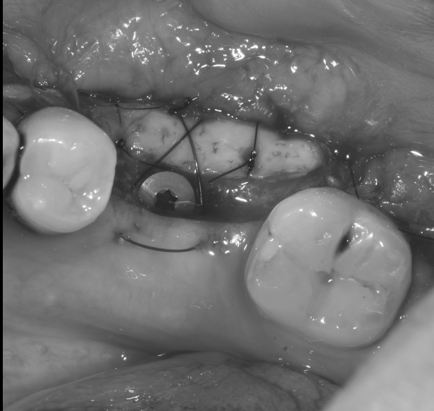 【池袋｜歯周病・インプラントの長期安定のために】FGG・口腔前庭拡張術という選択