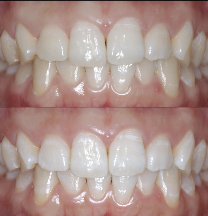 ホワイトニングのご紹介