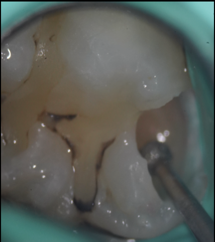 池袋で丁寧な虫歯治療を