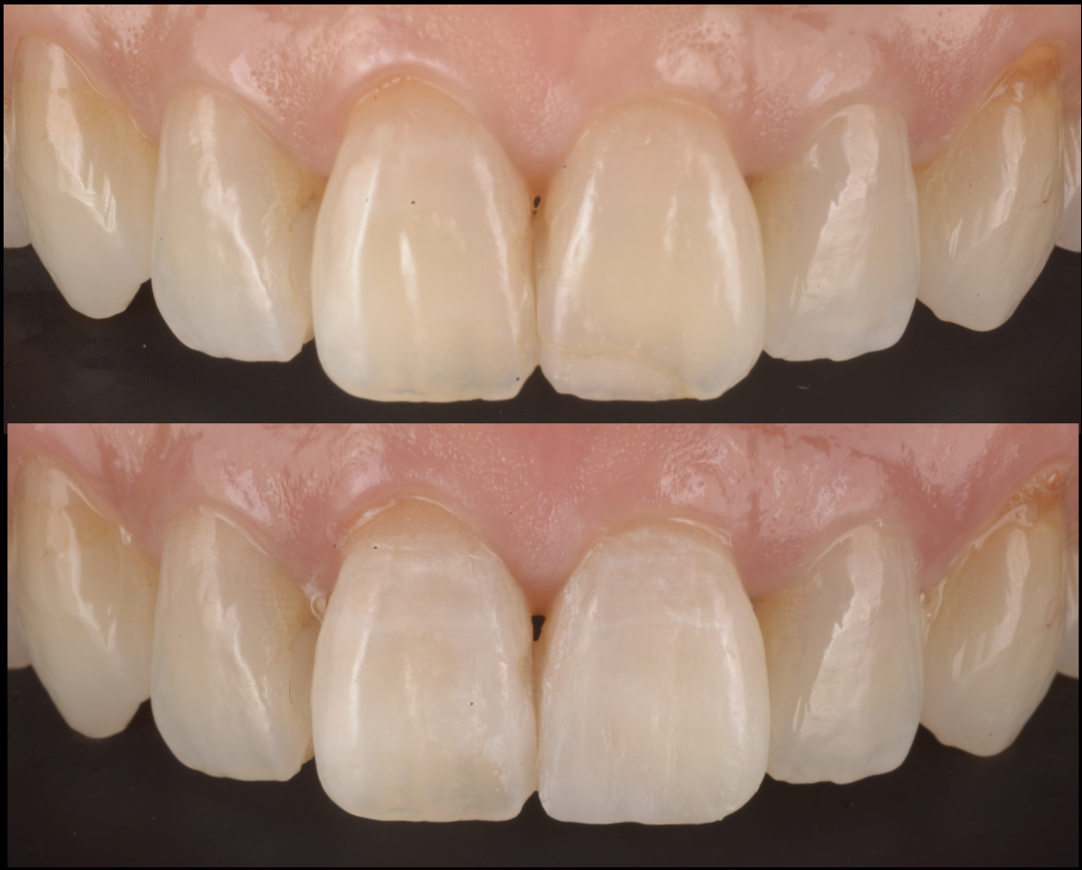 [池袋で丁寧な虫歯治療]小さな虫歯だからこそ、歯の寿命を延ばす精密治療を