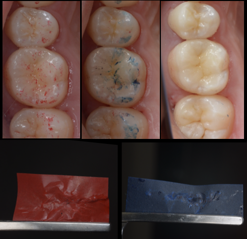 【池袋】セラミック治療後に歯が沁みる…それ、虫歯じゃなくて“噛み合わせ”かもしれません