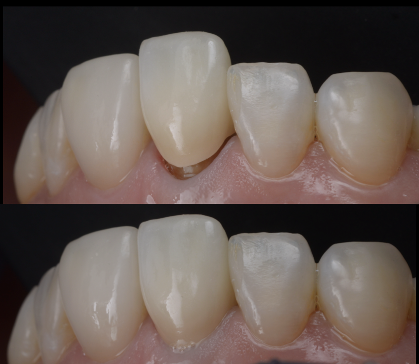 前歯1本のセラミック治療 ― シングルセントラルを自然に仕上げる当院のこだわり