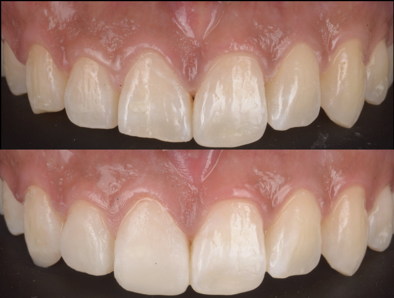 歯ぎしりで犬歯や前歯が削れてしまった方へ ― マウスピースだけではない包括的治療