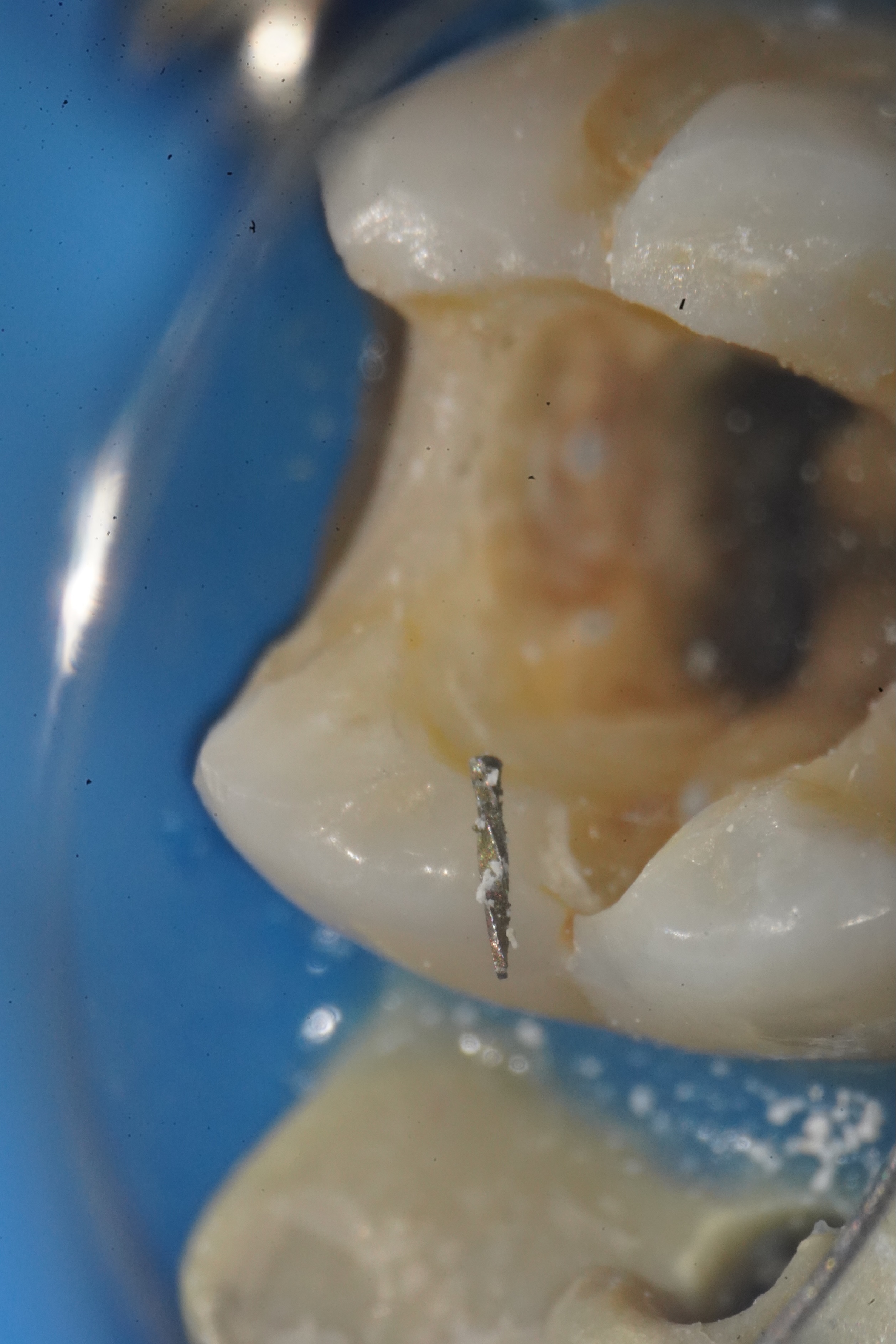 池袋で根管治療中のファイル破折｜取る？残す？再治療と外科の判断基準【グランドメゾンデンタルクリニック】