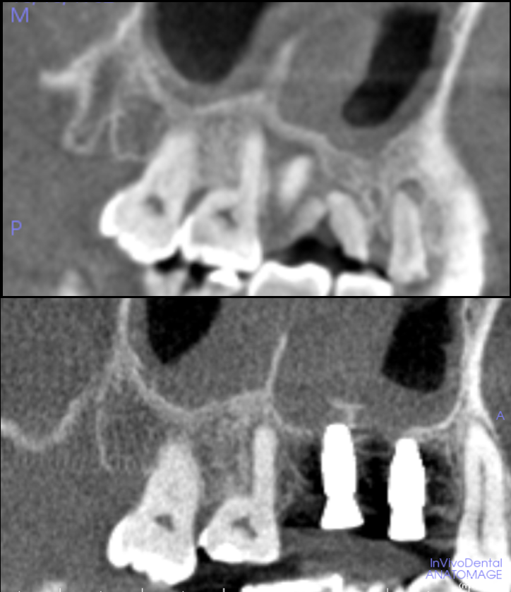 [池袋　歯医者]サイナスリフトを回避できる？低侵襲な『ソケットリフト』とは