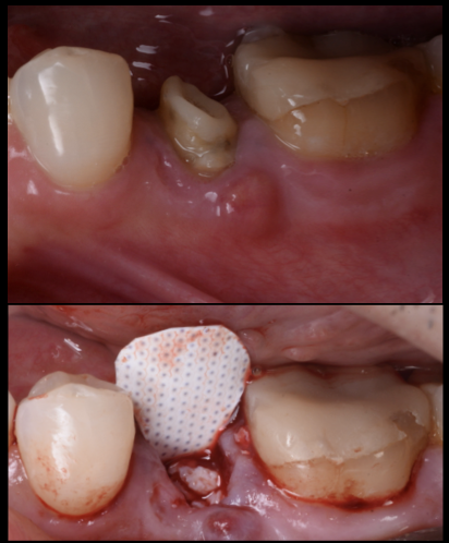 【グランドメゾンデンタルクリニック】抜歯後の骨を守る「ソケットプリザベーション」とは？