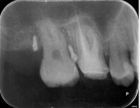 [池袋　歯医者]インプラントやセラミック治療の前に行う「矯正的歯の圧下」って何？