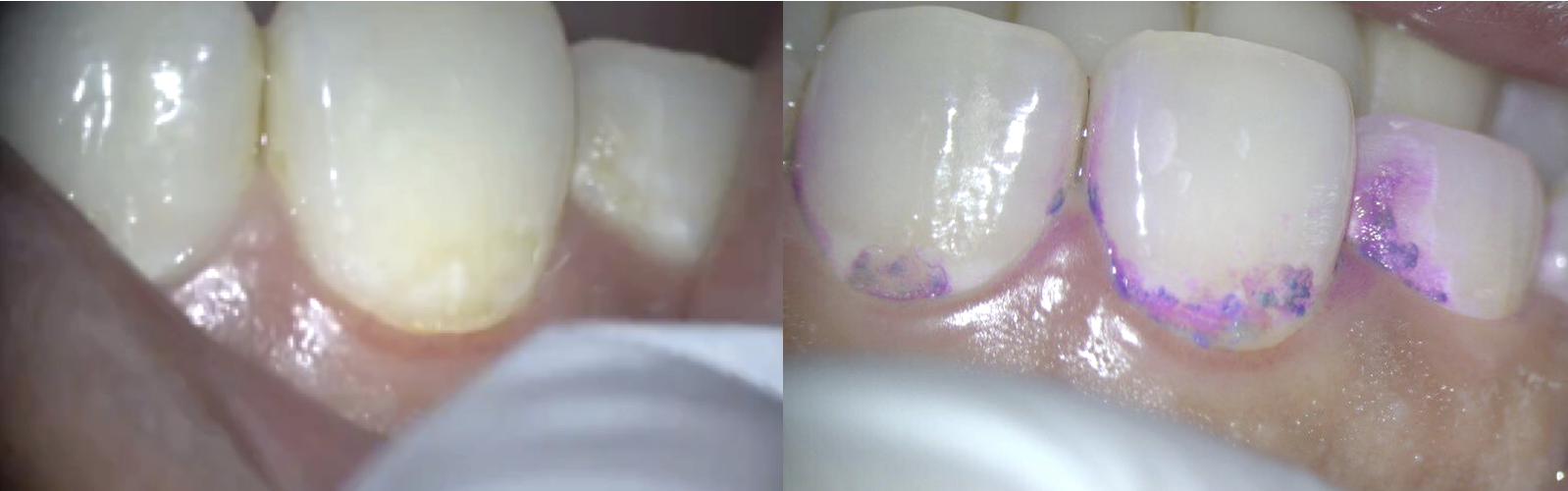 【池袋 歯医者】EMSのGBTとは？次世代のパウダークリーニングで快適・効果的な歯のメンテナンス